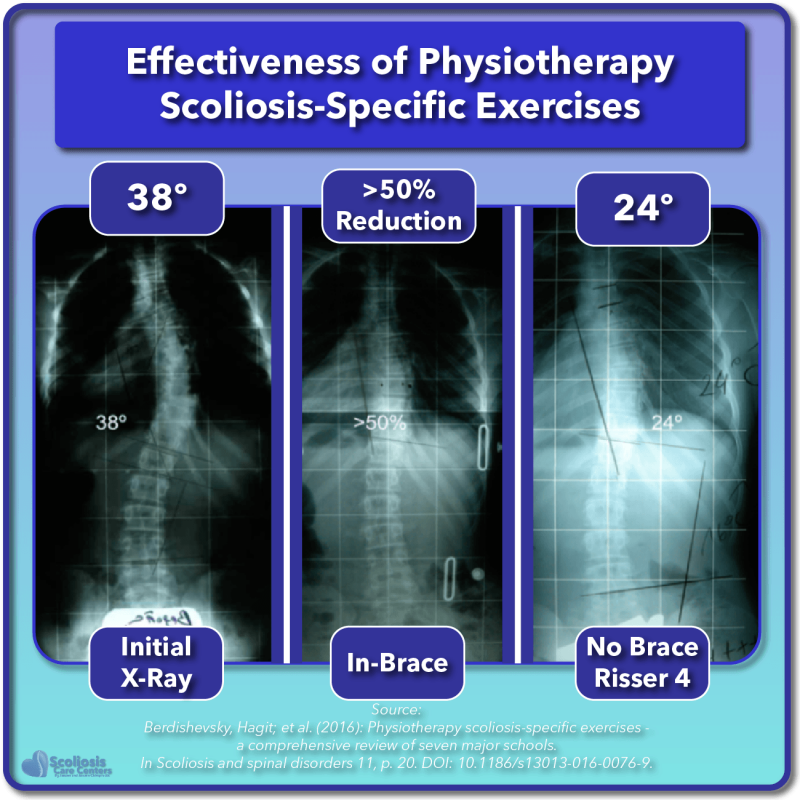 Scoliosis Treatment for Children and Teens - Scoliosis Care Centers