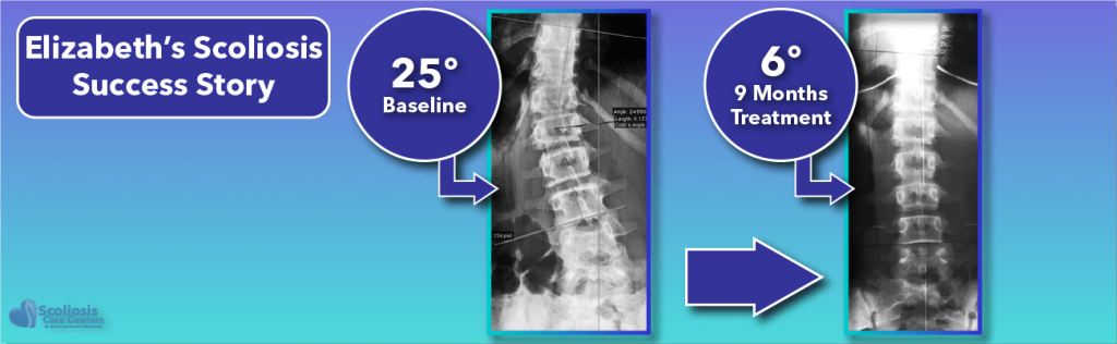 Elizabeth's 25 degree scoliosis success story following non-surgical treatment