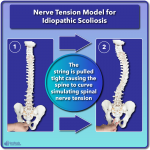 What is Scoliosis? Scoliosis Defined & Its Causes - Scoliosis Care Centers