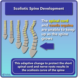 What is Scoliosis? Scoliosis Defined & Its Causes - Scoliosis Care Centers