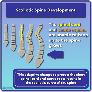 Example of scoliosis causing adaptive changes to nerve tension