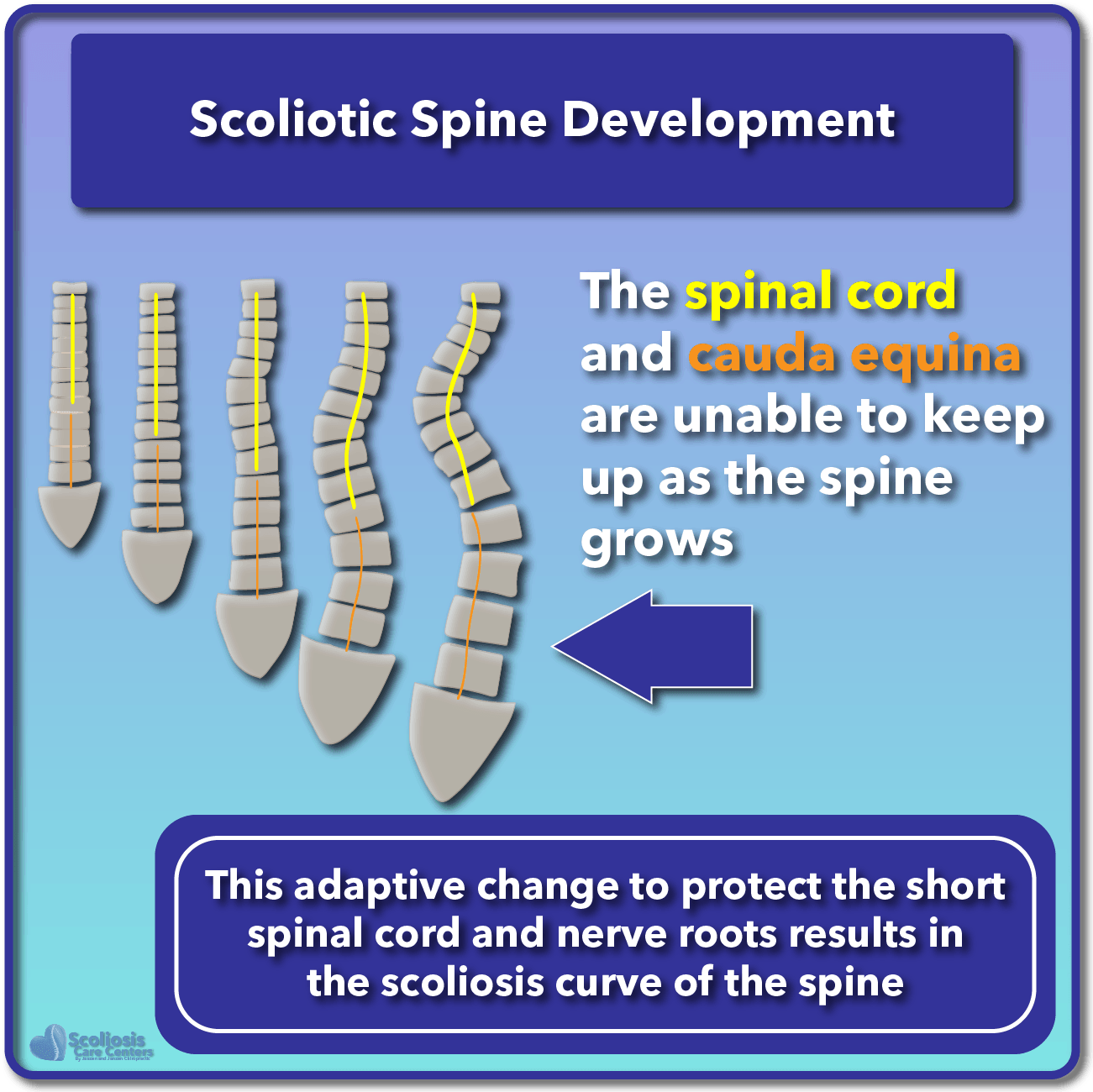 Why Does Scoliosis Get Worse With Growth? Scoliosis Care, 55% OFF