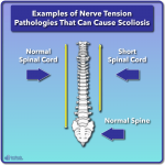 What is Scoliosis? Scoliosis Defined & Its Causes - Scoliosis Care Centers