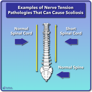 Examples of nerve tension pathologies causing scoliosis