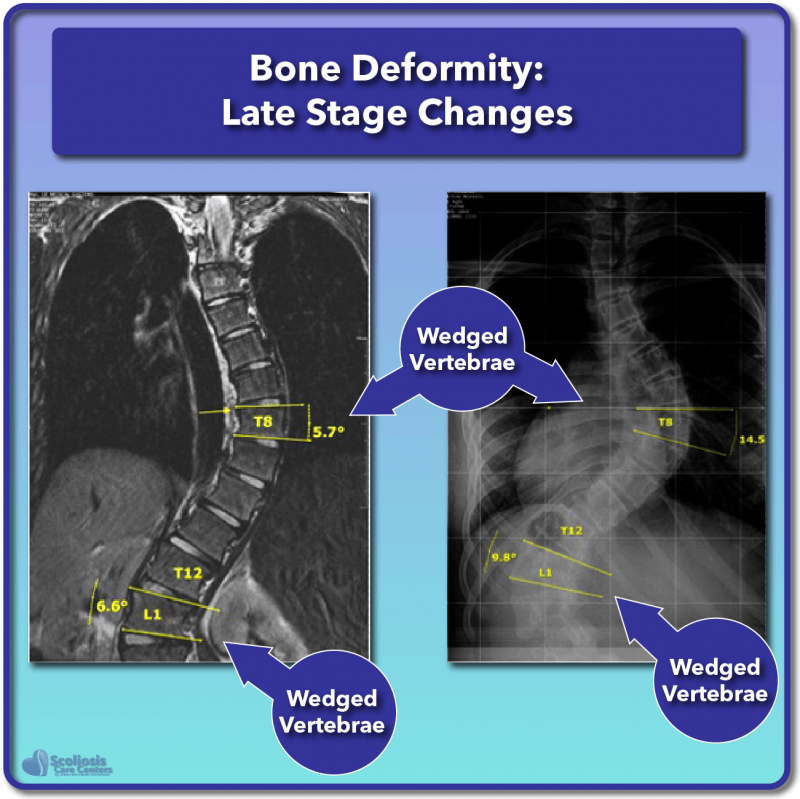 What is Scoliosis? Scoliosis Defined & Its Causes Scoliosis Care Centers