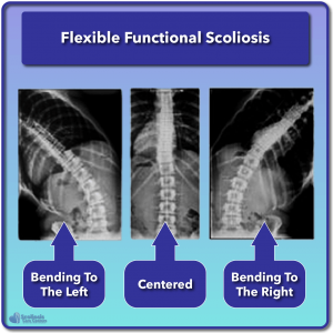 Example of a flexible functional scoliosis in three positions