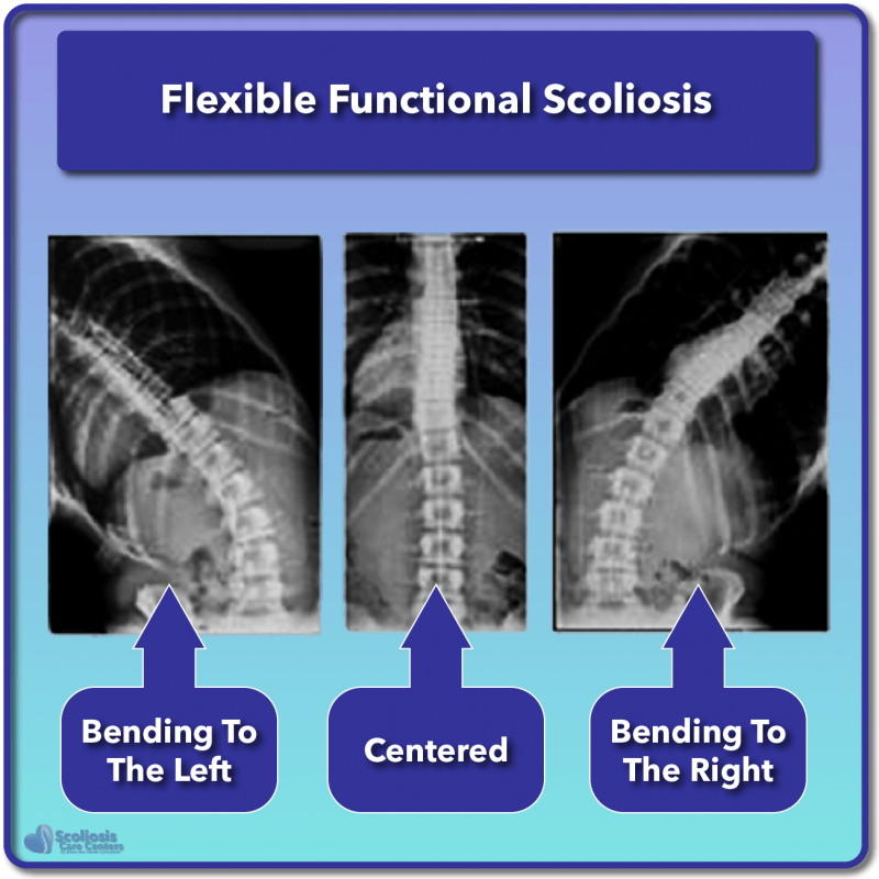 What is Scoliosis? Scoliosis Defined & Its Causes Scoliosis Care Centers