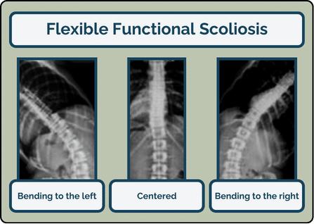 Structural Scoliosis & Functional Scoliosis