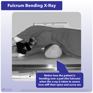 Example of fulcrum bending x-ray