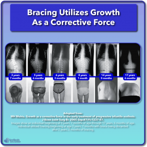 Scoliosis research bracing utilizes growth as a corrective force curve reduction example