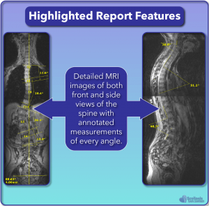 Highlighted Scoliosis Report Features: MRI imaging of the spine from multiple views