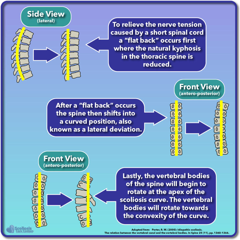 Why Does Scoliosis Get Worse With Growth? Scoliosis Care Centers