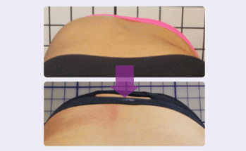 Rib hump improvement scoliosis case studies