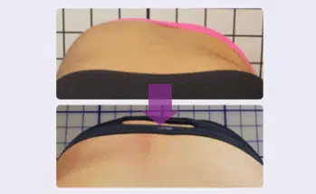 Rib hump improvement case studies