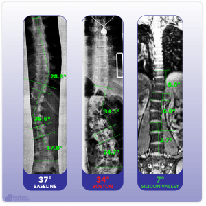 X-ray showing significantly improved in-brace correction with the Silicon Valley Brace