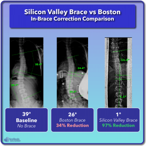 Boston in-brace scoliosis correction compared to Silicon Valley Brace