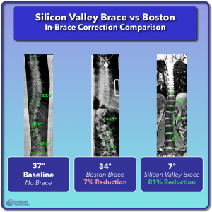 Boston in-brace scoliosis correction compared to Silicon Valley Brace Example #3