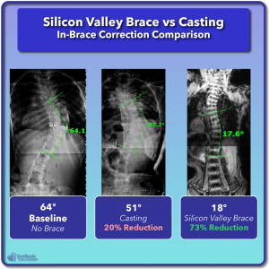 Casting scoliosis correction compared to Silicon Valley Brace