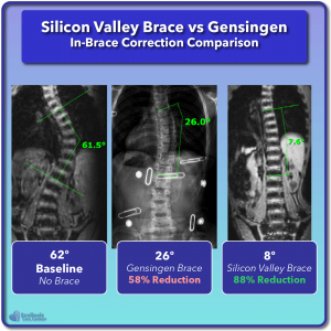 Gensingen in-brace scoliosis correction compared to Silicon Valley Brace