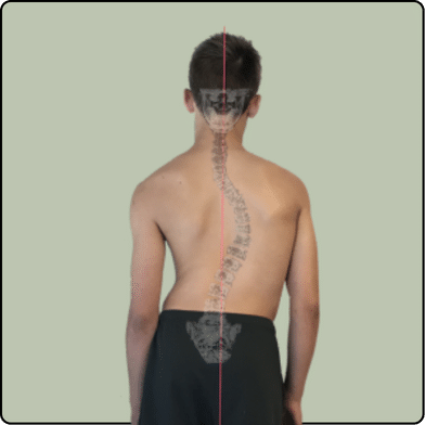 Scoliosis Diagram