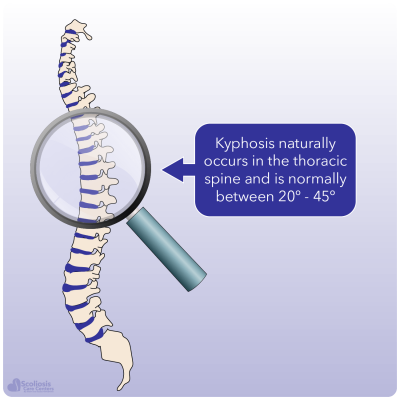 Kyphosis and Hyperkyphosis - What it is, how it happens, and what to do