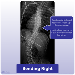 Example of right scoliosis curve persisting during lateral bending xray
