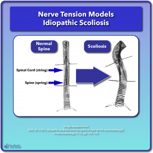 Nerve tension model for idiopathic scoliosis