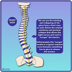 Why Does Scoliosis Get Worse With Growth? - Scoliosis Care Centers