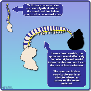 Side view of spine illustrating nerve tension