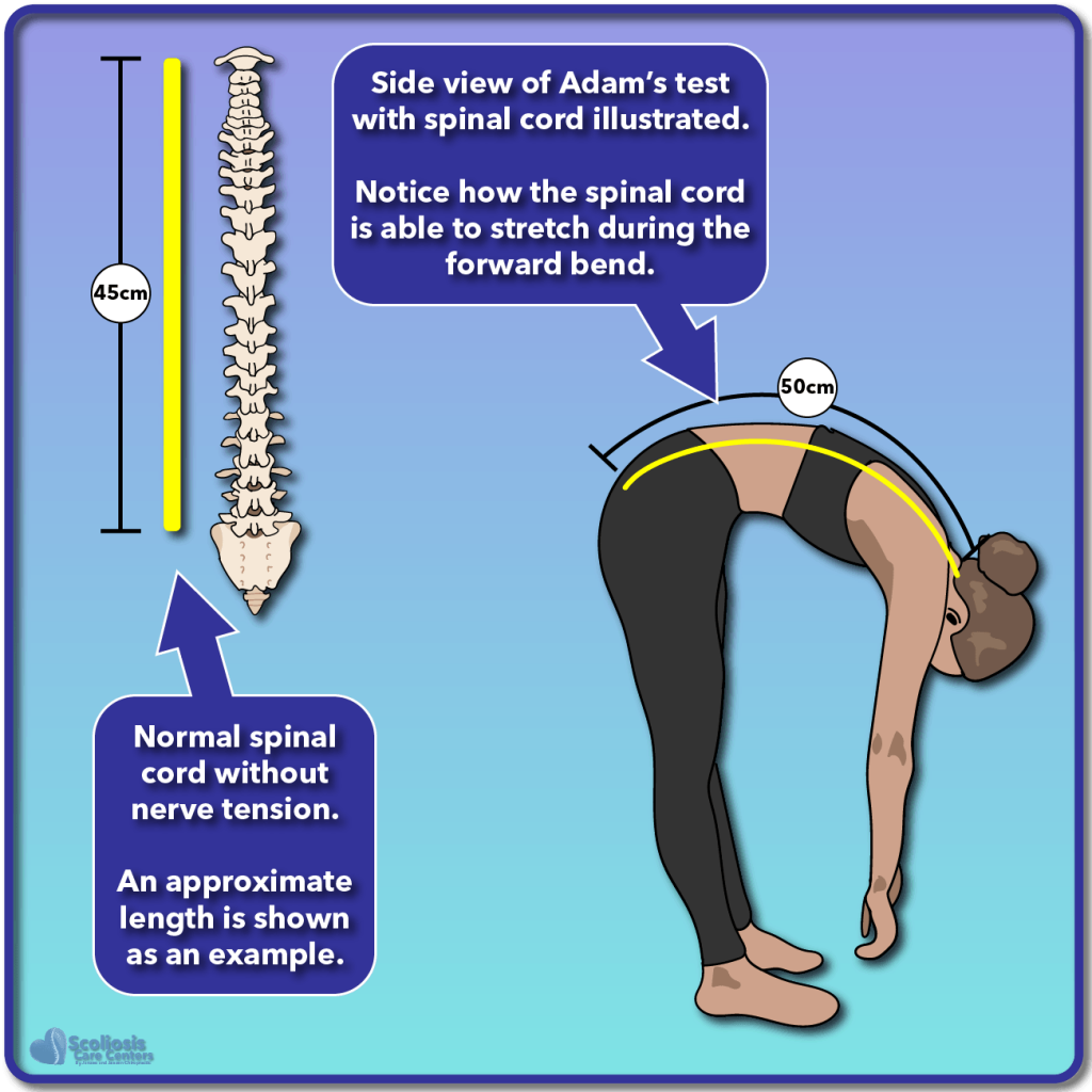 Scoliosis Rib Hump Results Scoliosis Care Centers
