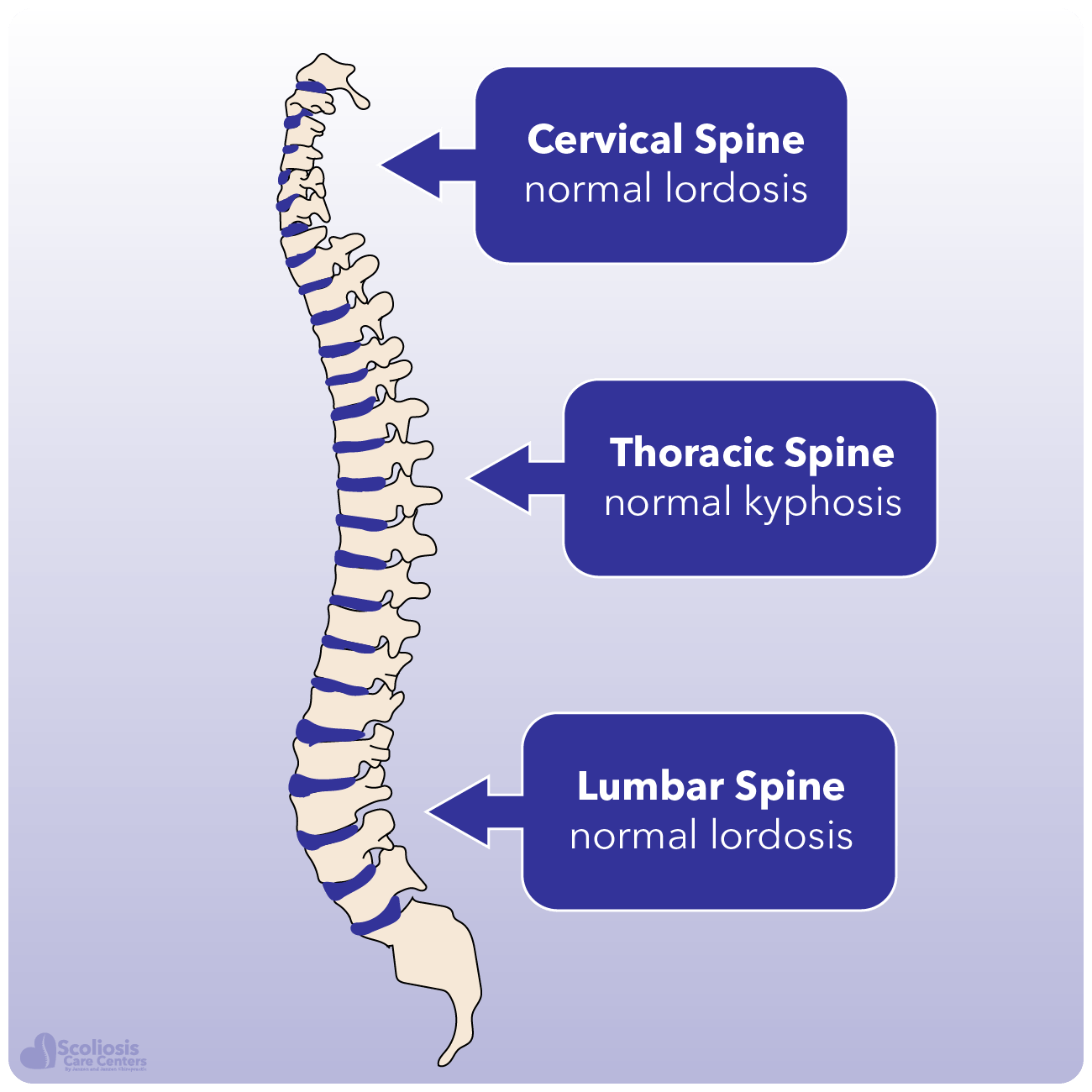 Thoracic Lumbar Sacral Orthosis with Zero Degree Lordosis Curve