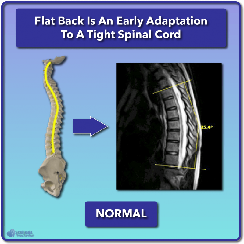 What is Scoliosis? Scoliosis Defined & Its Causes Scoliosis Care Centers