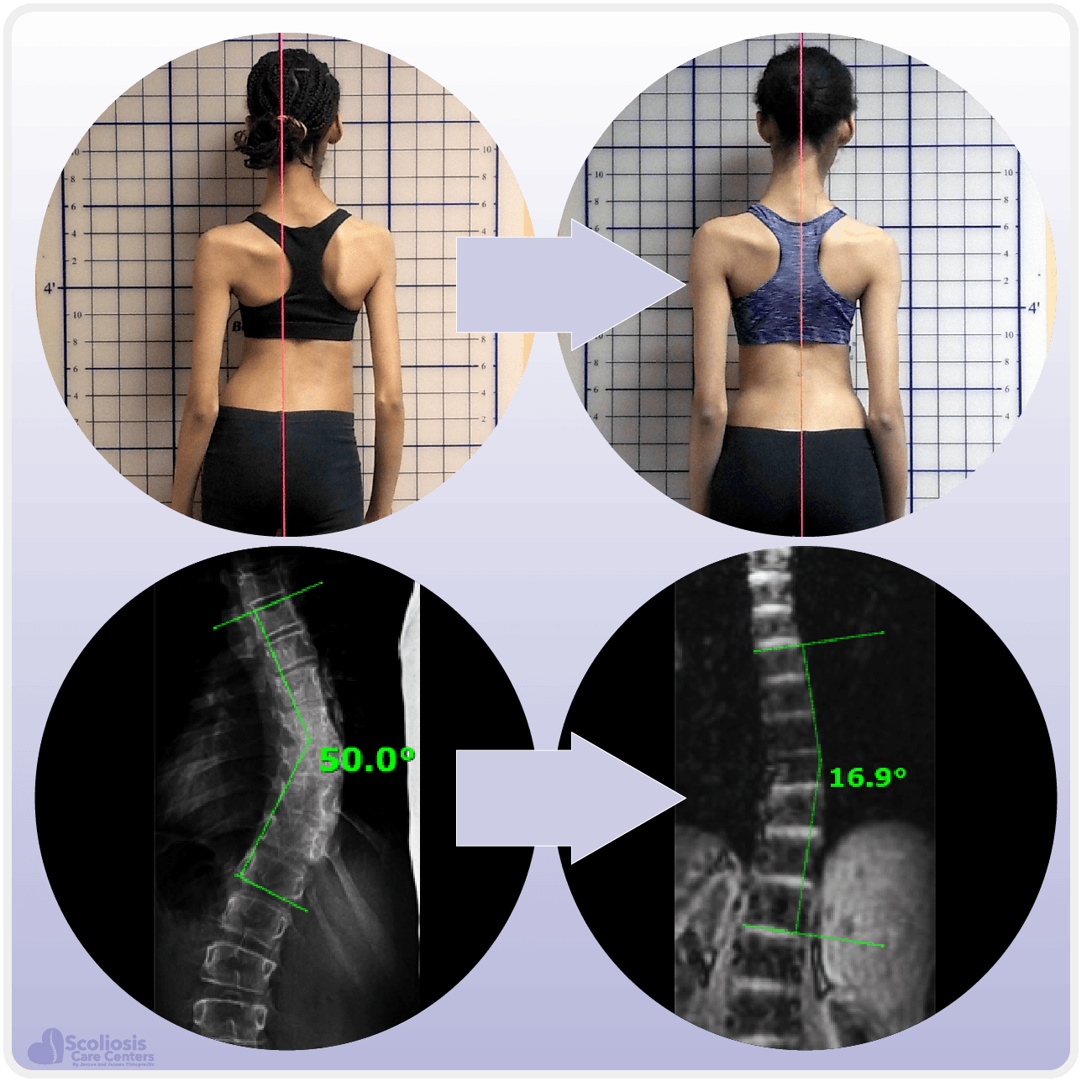 Scoliosis, Brace or Surgery?
