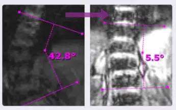 Before and after X-rays showing curve angle reduction