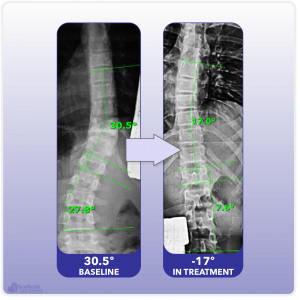 X-ray showing reduction and reversal of scoliosis curve in treatment