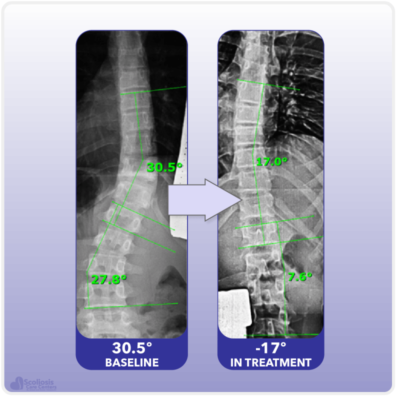 Silicon Valley Scoliosis Method: Effective Treatment Without Surgery