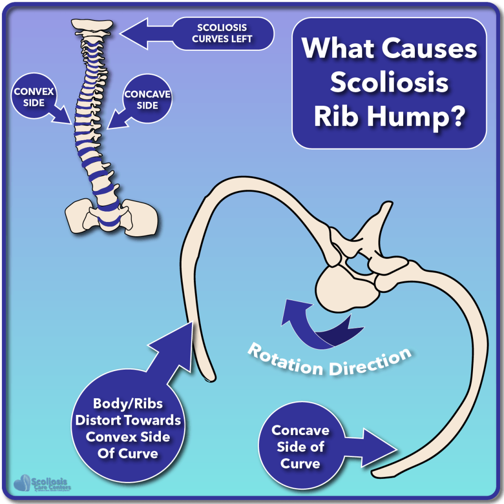 Nerve Tension and Scoliosis - Scoliosis Care Centers