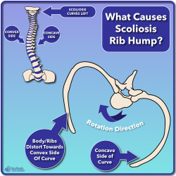 Nerve Tension and Scoliosis - Scoliosis Care Centers