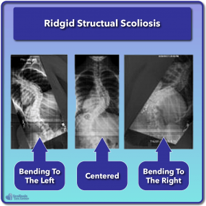 Example of a rigid structural scoliosis in three positions