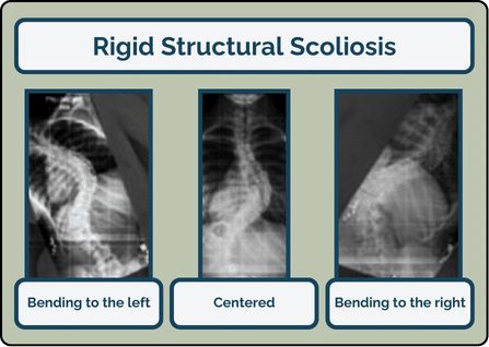 Structural Scoliosis & Functional Scoliosis