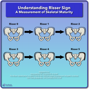 Illustrated guide to understanding risser sign as a measurement of skeletal maturity