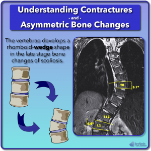 Asymmetric bone changes and wedged vertebrae in scoliosis