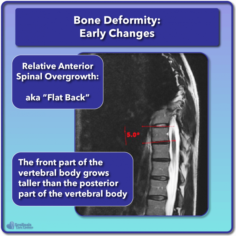 What is Scoliosis? Scoliosis Defined & Its Causes Scoliosis Care Centers