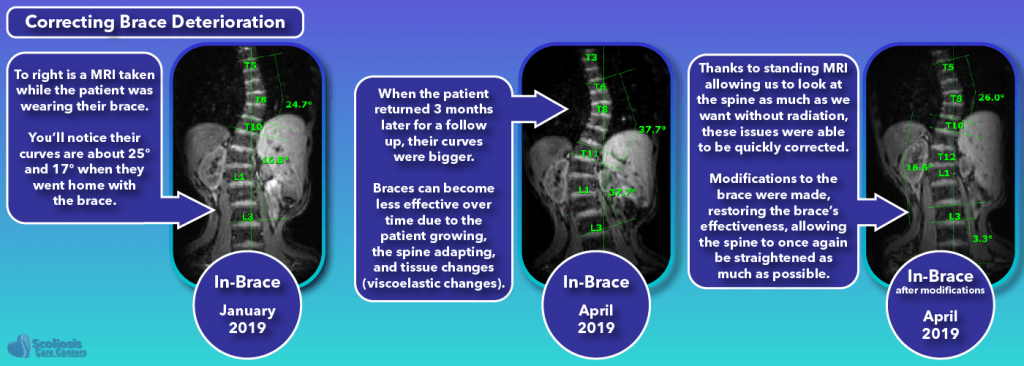 Scoliosis braces can deteriorate in performance over time and require modification to correct them