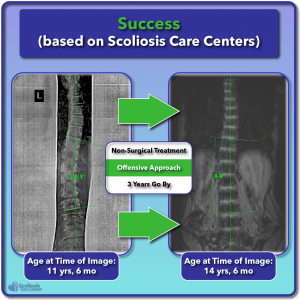 Example of scoliosis bracing success curve reduction over time