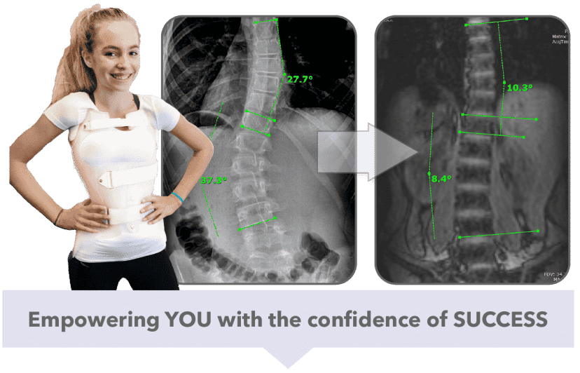 Scoliosis care centers banner with before and after treatment pics