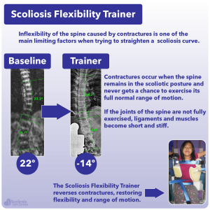 Explanation of contractures and image of patient in the Scoliosis Flexibility Trainer restoring range of motion to the spine