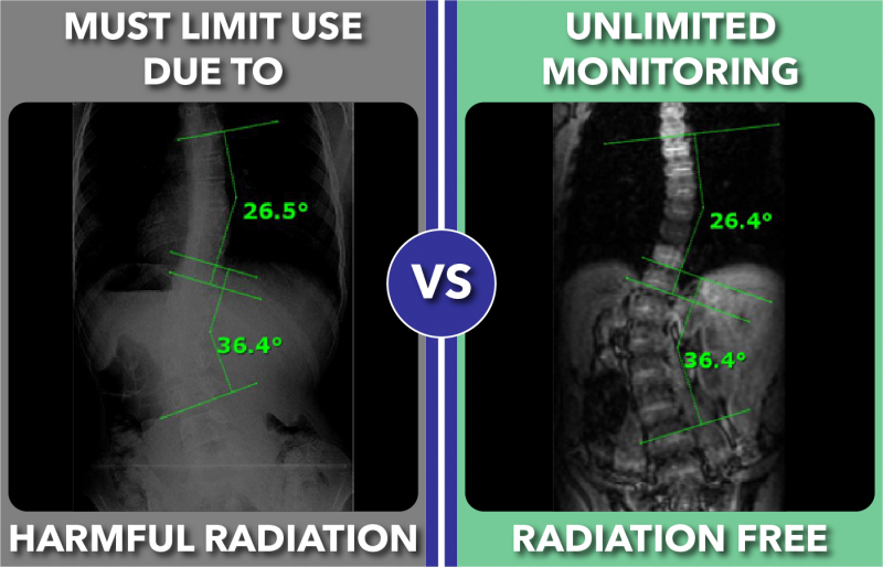 Scoliosis MRI Monitoring Radiation Free Scoliosis Care Centers