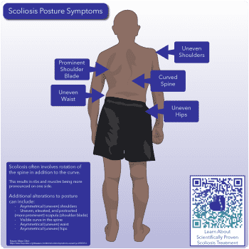 Diagram detailing the impacts scoliosis can have on a patient's posture