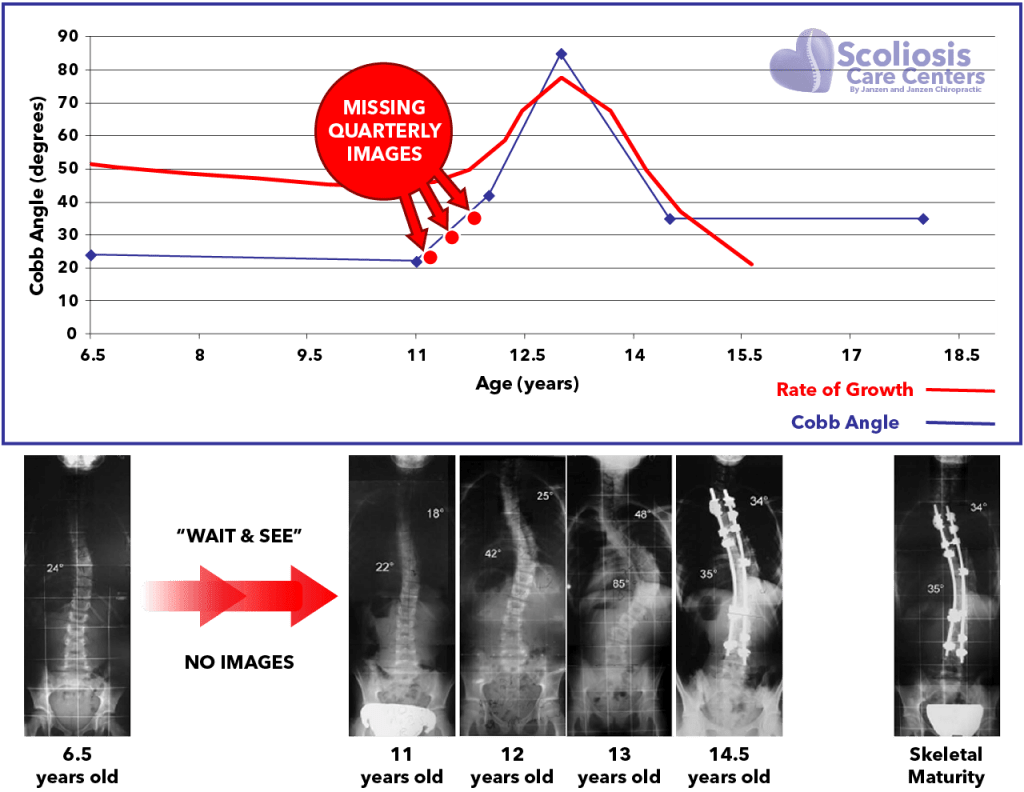 Graph and images of scoliosis progression and rate of growth during puberty